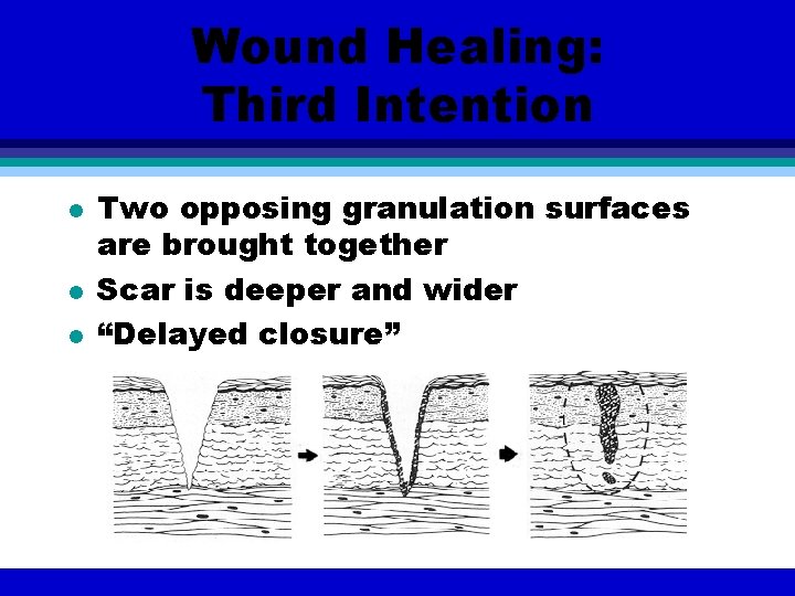 Wound Healing: Third Intention l l l Two opposing granulation surfaces are brought together