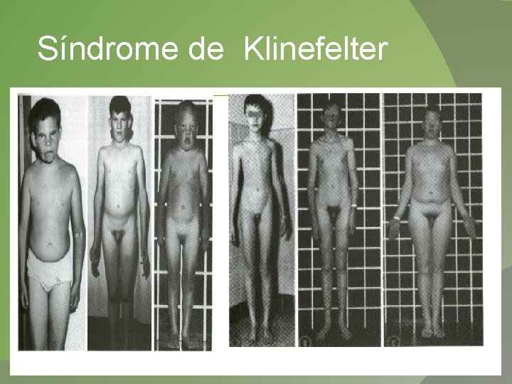 Síndrome de Klinefelter 