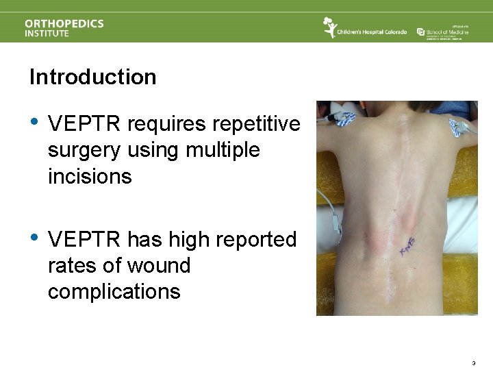 Introduction • VEPTR requires repetitive surgery using multiple incisions • VEPTR has high reported