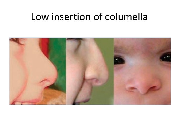 Low insertion of columella 