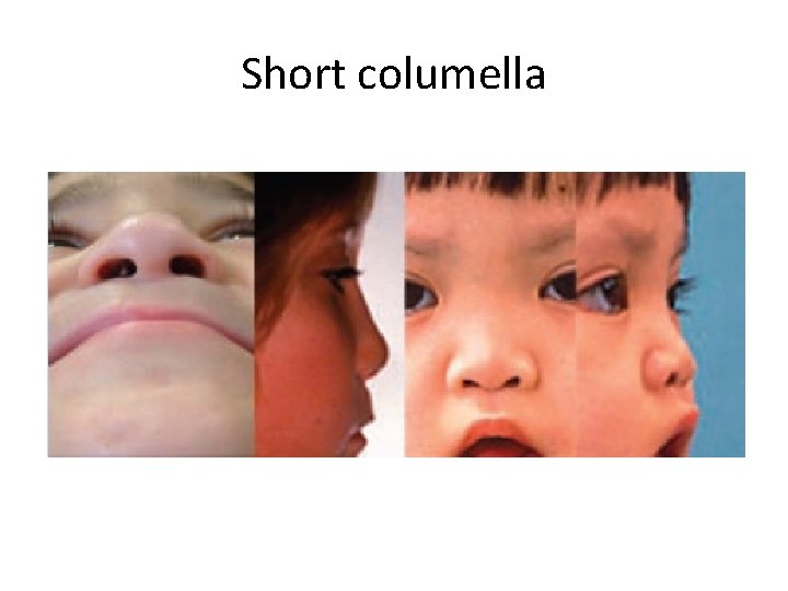 Short columella 