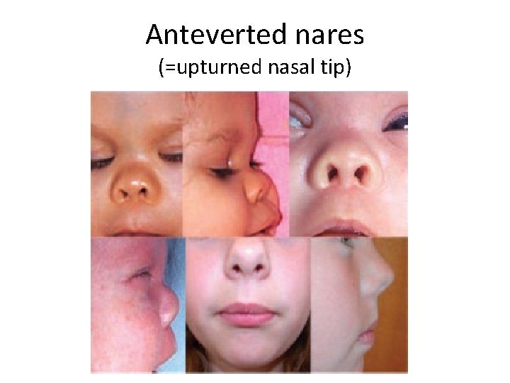 Anteverted nares (=upturned nasal tip) 