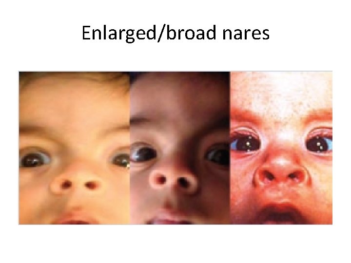 Enlarged/broad nares 