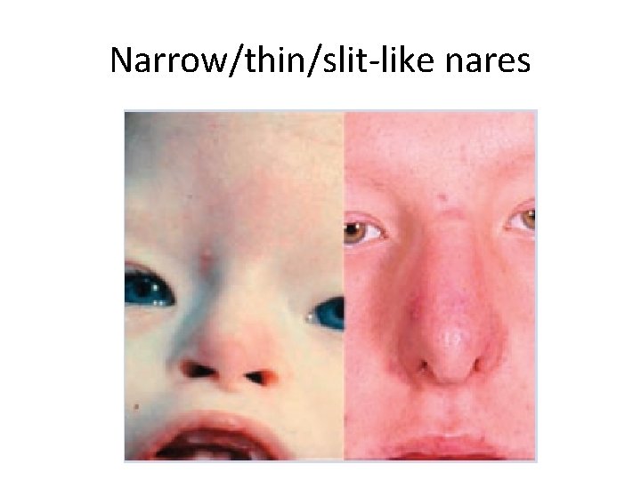 Narrow/thin/slit-like nares 