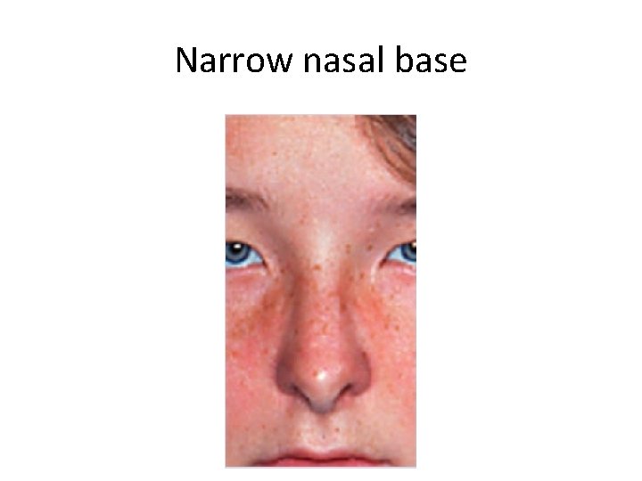 Narrow nasal base 