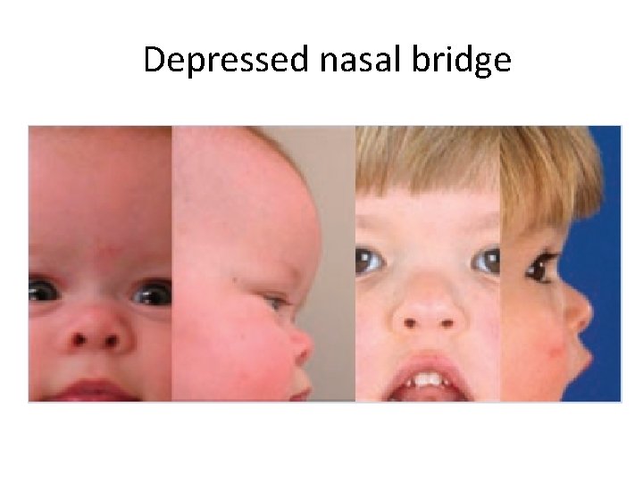 Depressed nasal bridge 