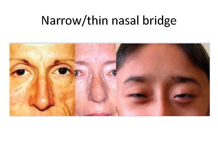 Narrow/thin nasal bridge 