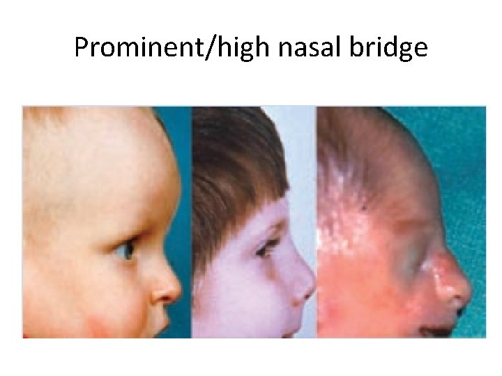 Prominent/high nasal bridge 
