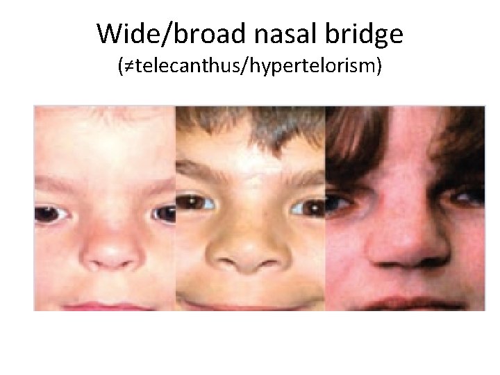 Wide/broad nasal bridge (≠telecanthus/hypertelorism) 