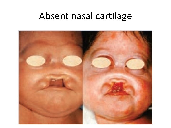 Absent nasal cartilage 