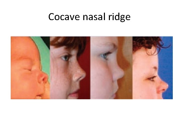 Cocave nasal ridge 