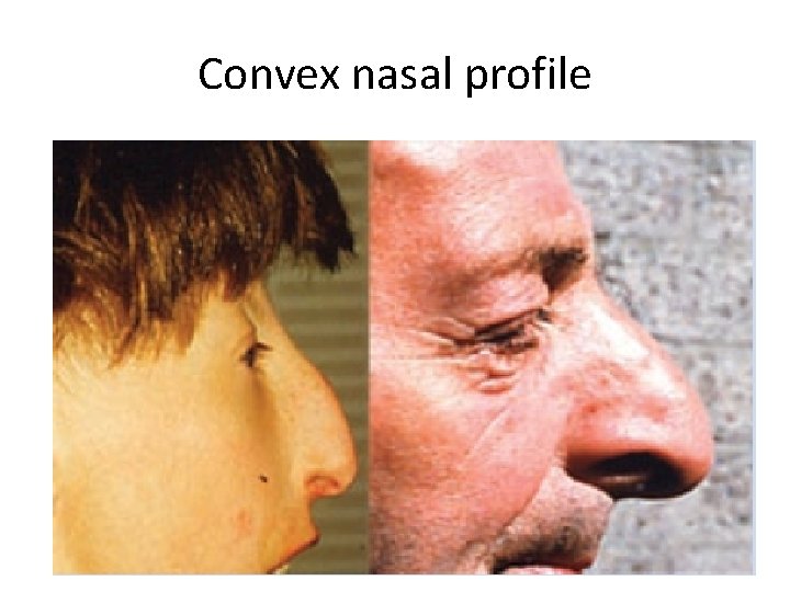Convex nasal profile 