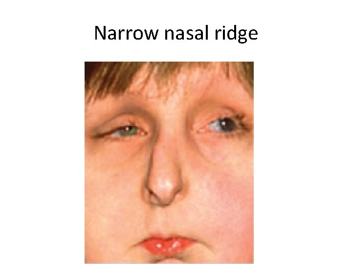 Narrow nasal ridge 