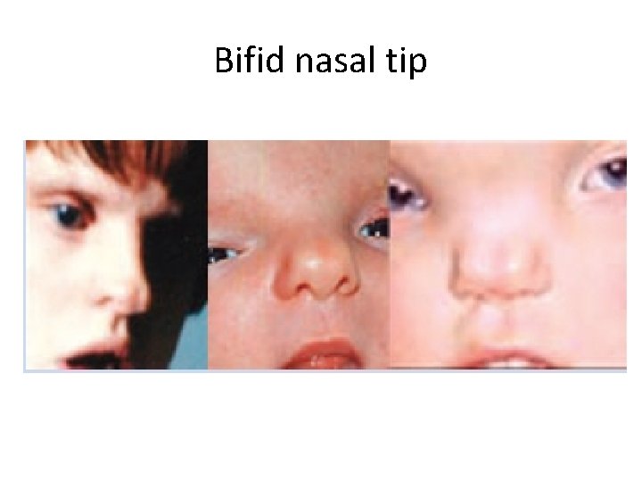 Bifid nasal tip 
