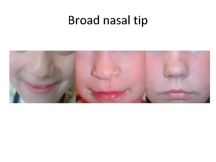 Broad nasal tip 