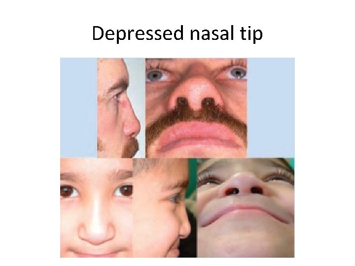 Depressed nasal tip 