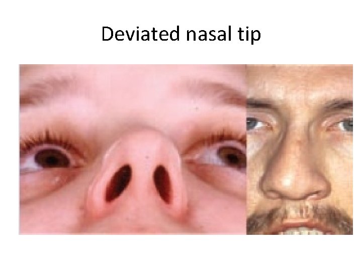Deviated nasal tip 