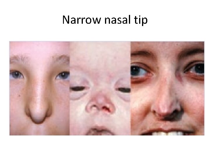 Narrow nasal tip 