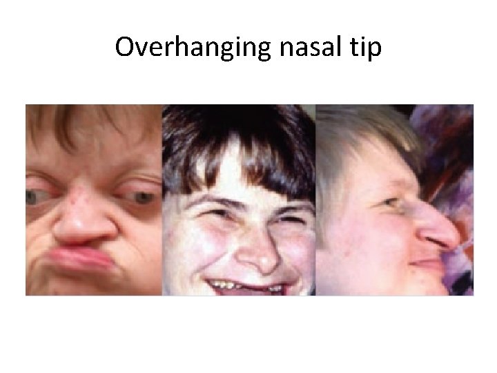 Overhanging nasal tip 