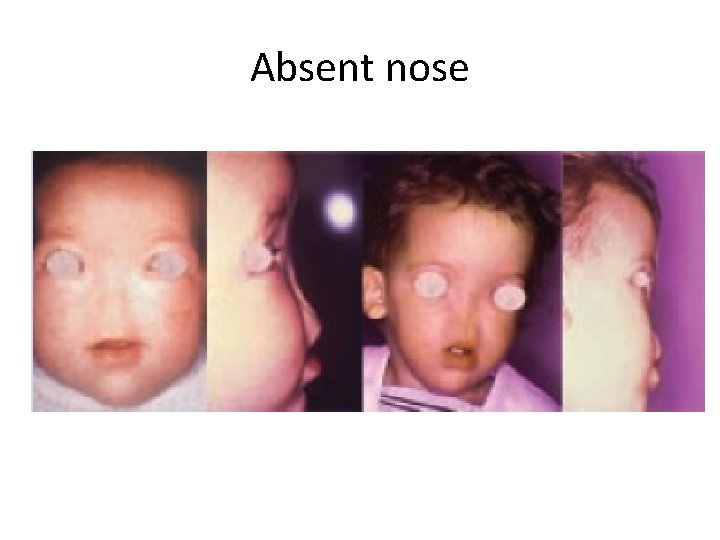 Absent nose 
