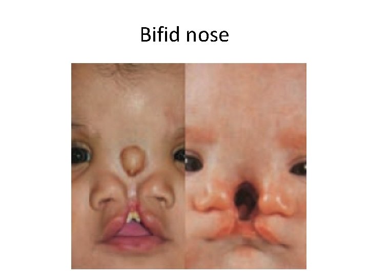 Bifid nose 
