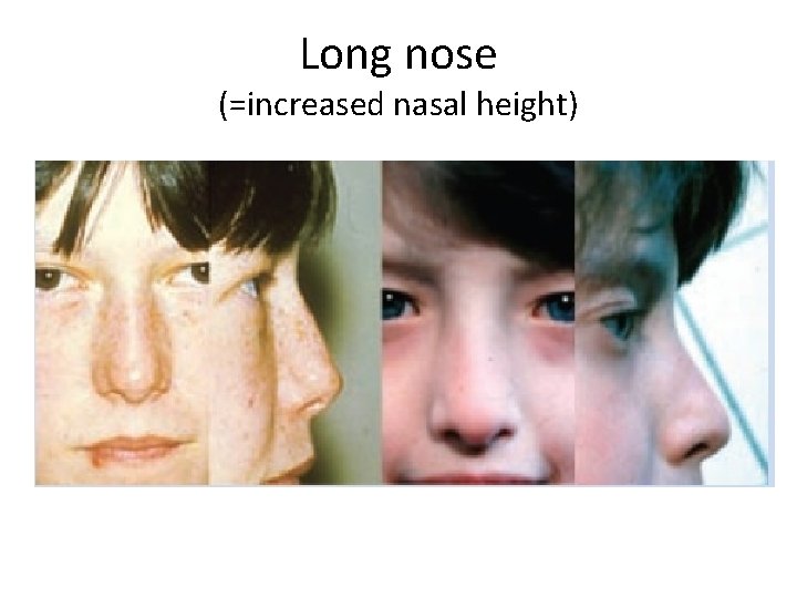 Long nose (=increased nasal height) 