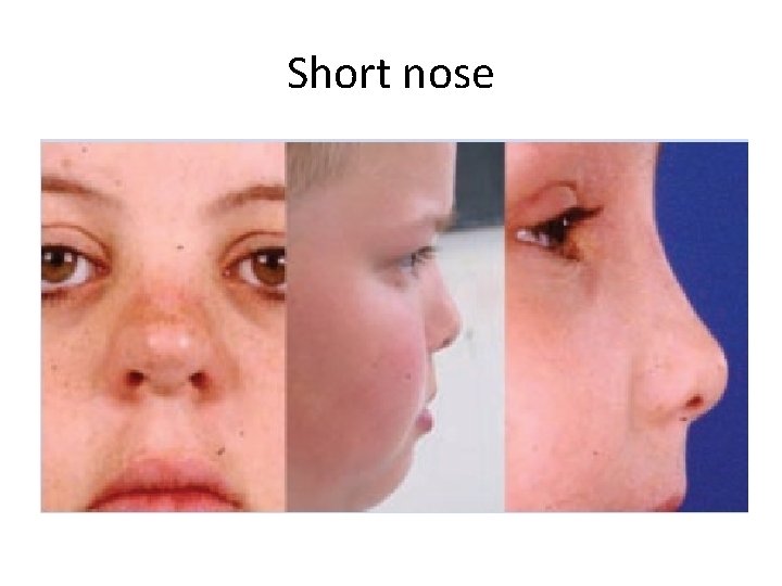Short nose 