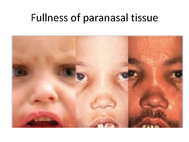 Fullness of paranasal tissue 