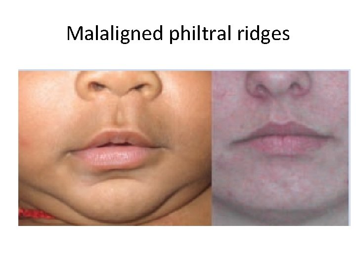 Malaligned philtral ridges 