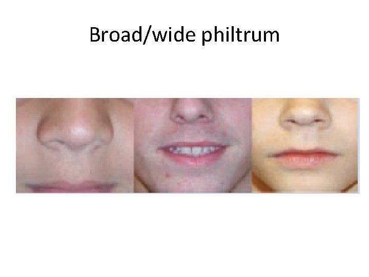 Broad/wide philtrum 