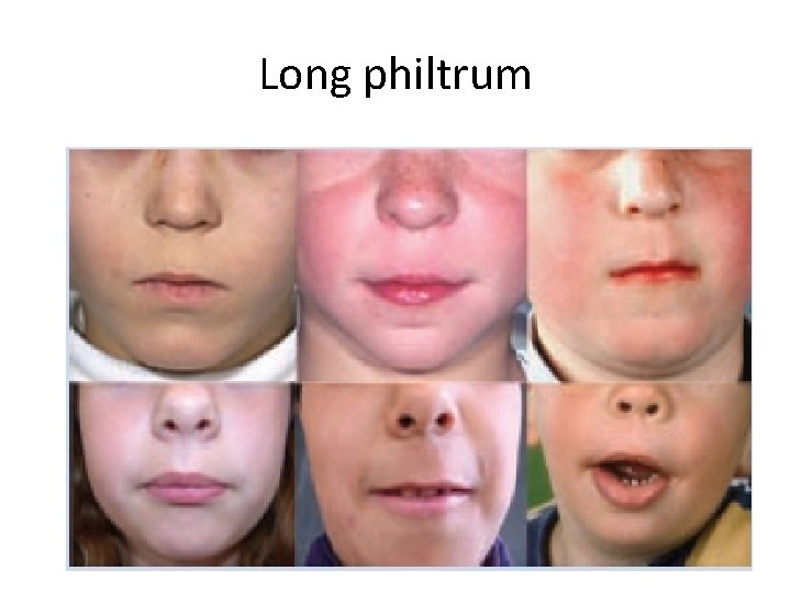 Long philtrum 