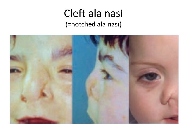 Cleft ala nasi (=notched ala nasi) 