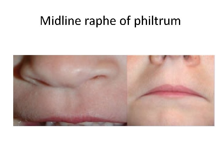 Midline raphe of philtrum 