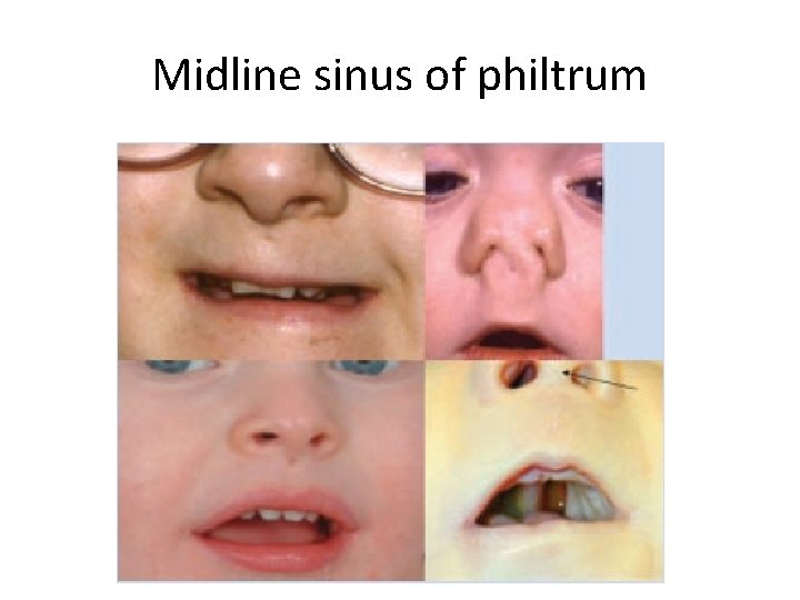 Midline sinus of philtrum 