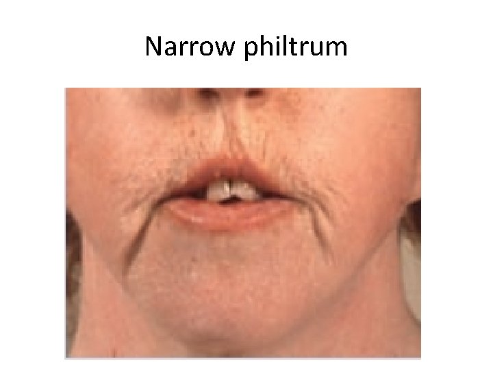 Narrow philtrum 