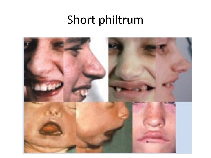 Short philtrum 