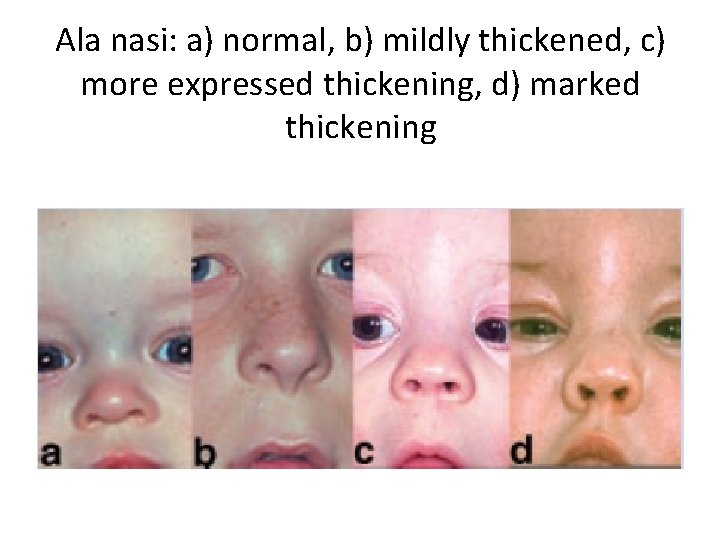 Ala nasi: a) normal, b) mildly thickened, c) more expressed thickening, d) marked thickening
