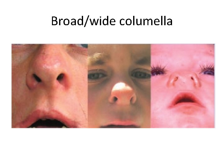 Broad/wide columella 