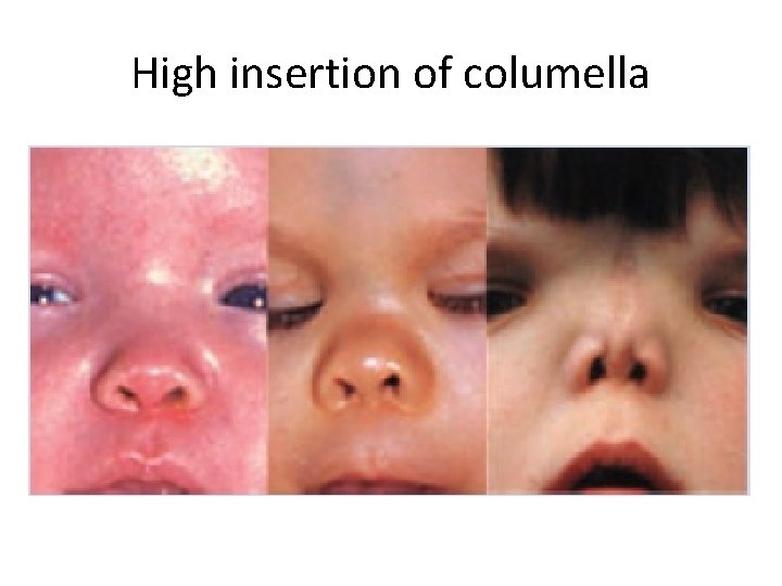 High insertion of columella 