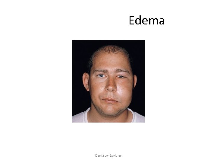 Edema Dentistry Explorer 