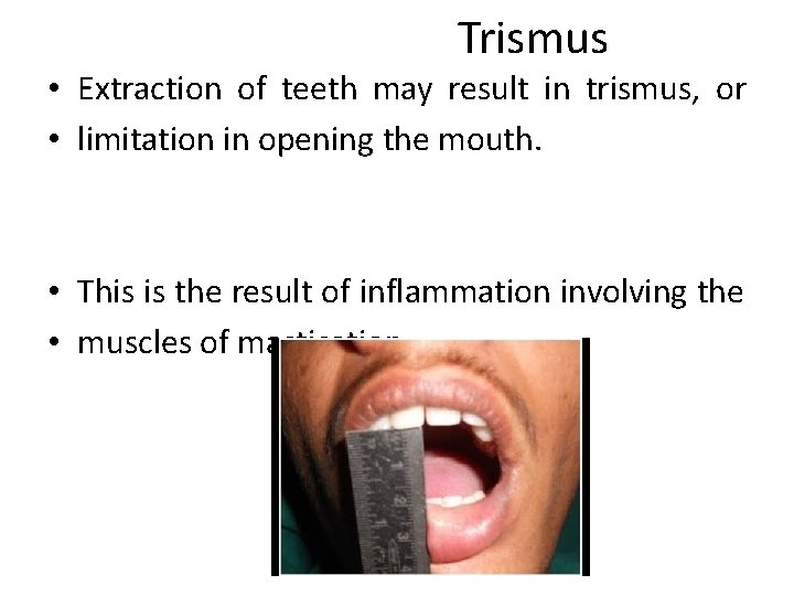 Trismus • Extraction of teeth may result in trismus, or • limitation in opening