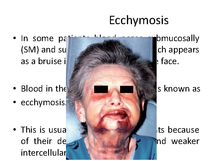 Ecchymosis • In some patients blood oozes submucosally (SM) and sub-cutaneously (SC), which appears