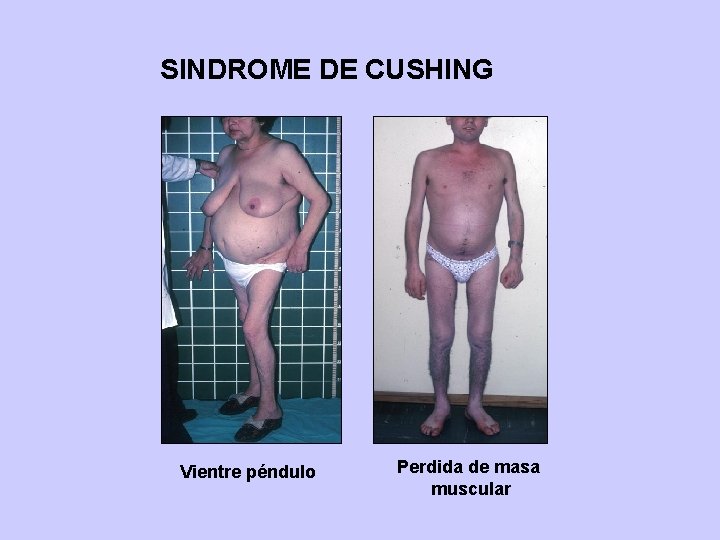 SINDROME DE CUSHING Vientre péndulo Perdida de masa muscular 