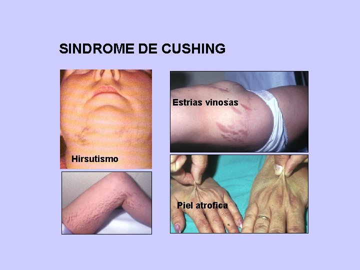 SINDROME DE CUSHING Estrias vinosas Hirsutismo Piel atrofica 