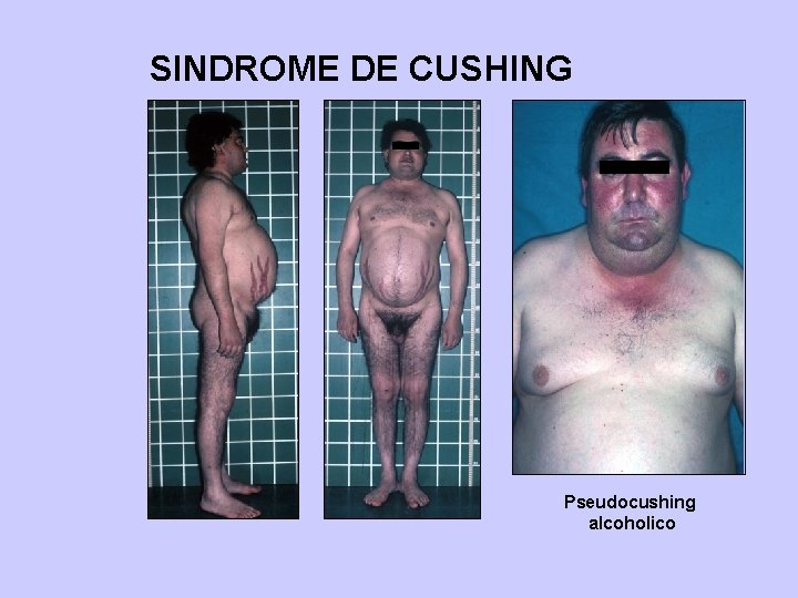 SINDROME DE CUSHING Pseudocushing alcoholico 