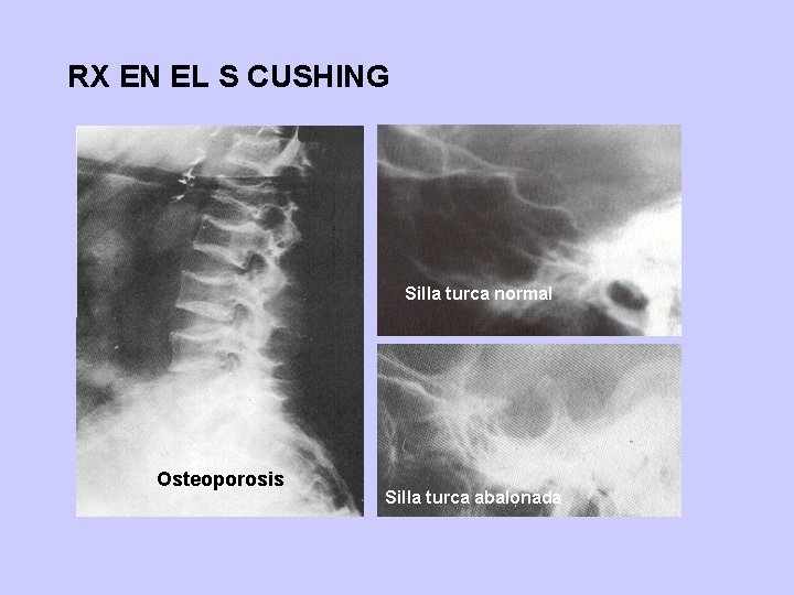 RX EN EL S CUSHING Silla turca normal Osteoporosis Silla turca abalonada 