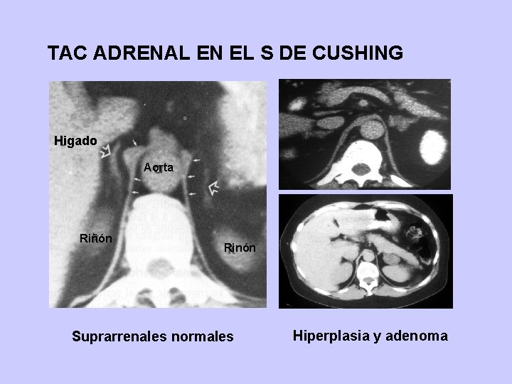 TAC ADRENAL EN EL S DE CUSHING Higado Aorta Riñón Rinón Suprarrenales normales Hiperplasia