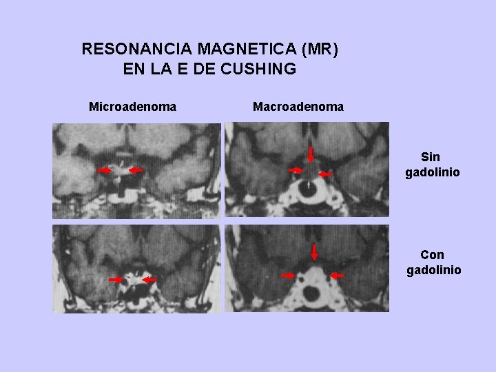 RESONANCIA MAGNETICA (MR) EN LA E DE CUSHING Microadenoma Macroadenoma Sin gadolinio Con gadolinio