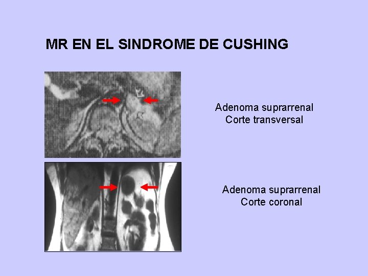 MR EN EL SINDROME DE CUSHING Adenoma suprarrenal Corte transversal Adenoma suprarrenal Corte coronal