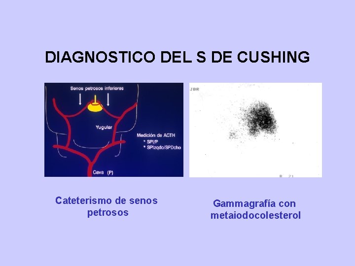 DIAGNOSTICO DEL S DE CUSHING Cateterismo de senos petrosos Gammagrafía con metaiodocolesterol 